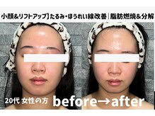 サロンスペース/20代 女性【小顔&リフトアップ】