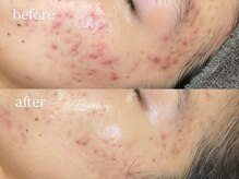 ビビ(Vivi)/ニキビケア