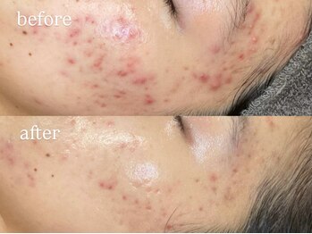 ビビ(Vivi)/ニキビケア