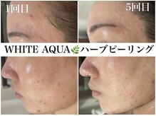 ホワイトアクア 浜松店(WHITE AQUA)/ハーブピーリング/ニキビケア