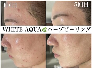 ホワイトアクア 浜松店(WHITE AQUA)/ハーブピーリング/ニキビケア