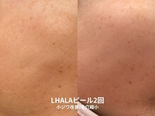 ピブ(pib.)/毛穴がキュっと！LHALAピール！