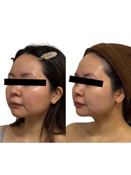 リノン(LIINON)/お顔が整うと気分も整う