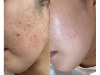 ハクビューティー(HAKU BEAUTY)/繰り返す大人ニキビさよならー