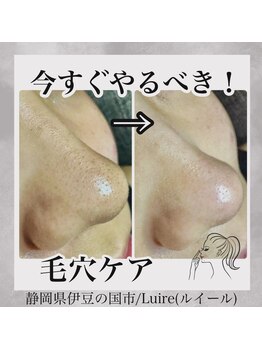 ルイール(Luire)/毛穴エクストラクションプロ