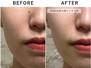 エムローズ(M.rose)/小顔リフトアップ全顔・首元