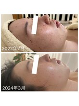 ルルボーテ(Loulou Beaute)/アンストレス×イラストリアス