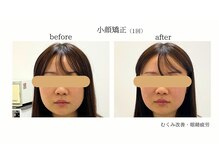 アボット(ABBOTT)/小顔矯正1回　10代