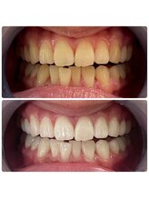 ユーラボ 表参道(YOU-LAB)/Befor/After【ホワイトニング】