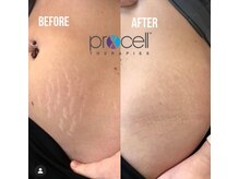 叶(Kanau)/プロセルセラピーズ妊娠線