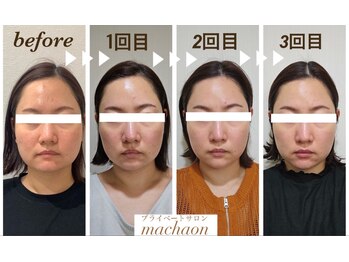 マカオン(machaon)/【小顔リフト】小顔マッサージ