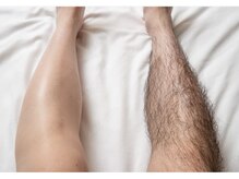 ウッドベル(WOODBELL)/メンズ全身脱毛