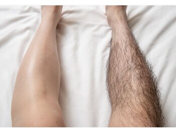 ウッドベル(WOODBELL)/メンズ全身脱毛