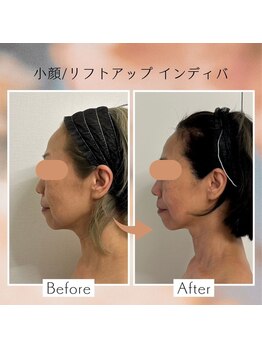 アピ(api)/症例写真【小顔インディバ】