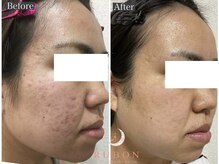 トータルビューティサロン ルボン(RUBON)/RUBONのニキビケア