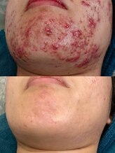 ソリッジ肌管理室/TIP集中プログラム