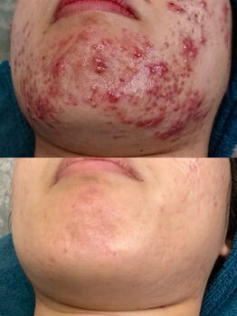 ソリッジ肌管理室/TIP集中プログラム