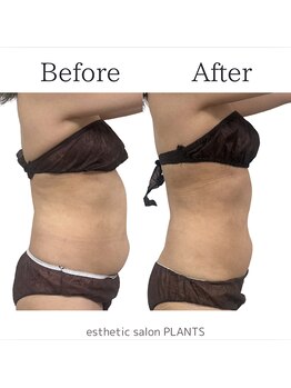 プランツ(PLANTS)/40代／６回／上半身痩せ