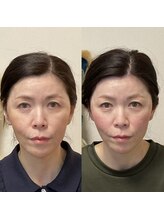 小顔22 ボルティ 本店(Bolty)/50代女性/中顔面矯正/12回目