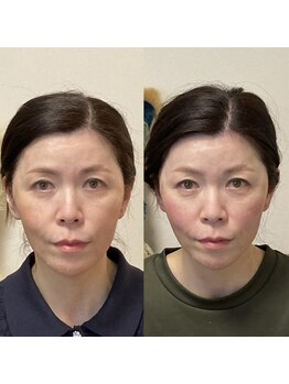 小顔22 ボルティ 本店(Bolty)/50代女性/中顔面矯正/12回目