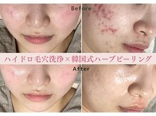 レクラ バイ ドクターエイチ(L'ECLAT by Doctor.H)の雰囲気（毛穴/赤み/くすみ/ニキビケア隠す肌から、見せたくなる肌へ）