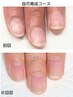 ［自爪育成］コンプレックスにさよなら！最強のネイルケア3ヶ月コース　