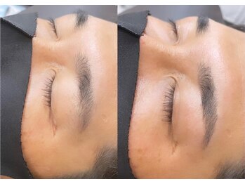 リンクス(links)の写真/【メンズも◎眉ワックス脱毛！】お顔の印象を左右する眉毛を綺麗に整えて美眉へ♪
