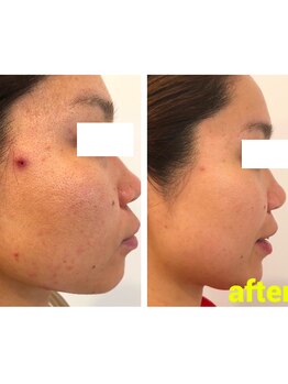 グロワール(gloire)/再生美容(ビフォーアフター)