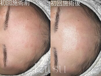 リツ(Ritsu)/かゆみ/敏感/赤み