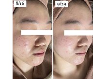 ホワイトアクア 岐阜店(WHITE AQUA)/ハーブピーリング/岐阜/ニキビ