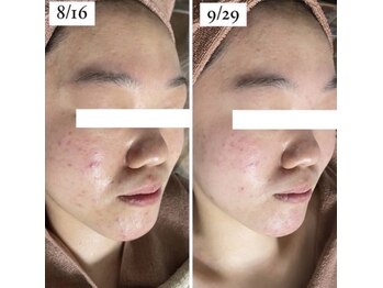 ホワイトアクア 岐阜店(WHITE AQUA)/ハーブピーリング/岐阜/ニキビ