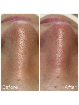 アトリエリン(Atelier Rin)/ハイドラフェイシャル