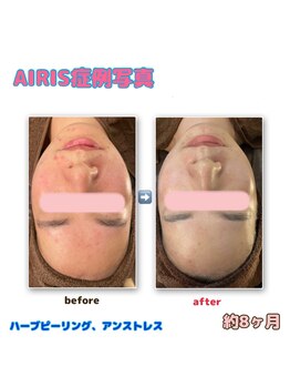 アイリス(AIRIS)/フェイシャル/毛穴洗浄/美白