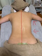 ミュー 新小岩店(Mieux)/ハイパーナイフEX 施術前/後