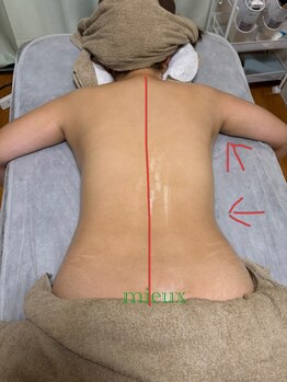 ミュー 新小岩店(Mieux)/ハイパーナイフEX 施術前/後