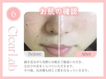 クリアラボ 上野(Clear Lab)/韓国肌管理&毛穴洗浄専門店