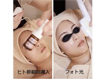 バリューネクスト 青葉台/◆お顔脱毛+ヒト幹細胞導入◆