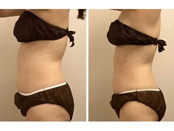 ルキア(LUKIA)/痩身【脂肪冷却】症例３　おなか