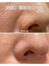 エイトルーム(8room)/☆顏脱毛☆毛穴角質ケアも含む