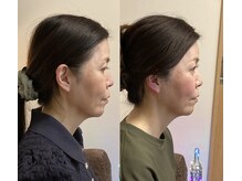 小顔22 ボルティ 本店(Bolty)/50代女性/中顔面矯正/12回目