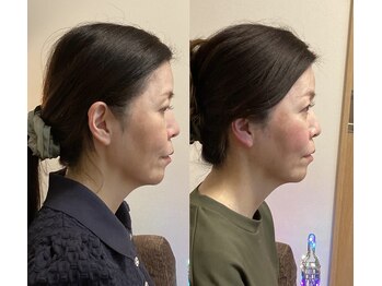 小顔22 ボルティ 本店(Bolty)/50代女性/中顔面矯正/12回目