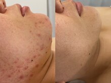 イメル(IMERU...)の雰囲気（渡韓不要！韓国生まれのハーブピーリングで叶ううるちゅる美肌☆）