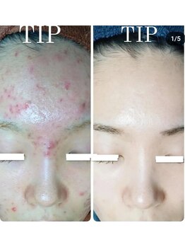 ビーピー 渋谷(b.p.)/ニキビケア