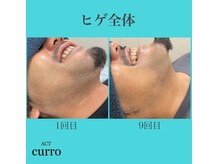 アクト クロ(ACT curro)/【ヒゲ全体】脱毛施術例