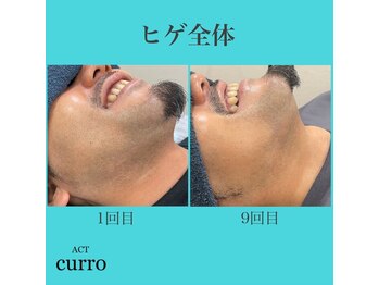 アクト クロ(ACT curro)/【ヒゲ全体】脱毛施術例
