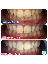 キラット 札幌店(Kiratt)/クリスタルホワイトニング