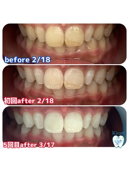 キラット 札幌店(Kiratt)/クリスタルホワイトニング