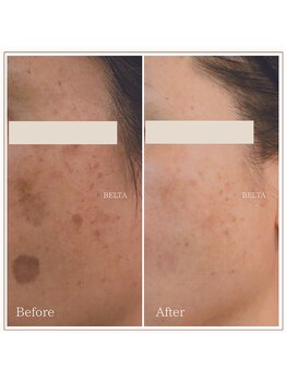 ベルタ(BELTA)/ケア前→11ヶ月後　シミ/雀卵斑