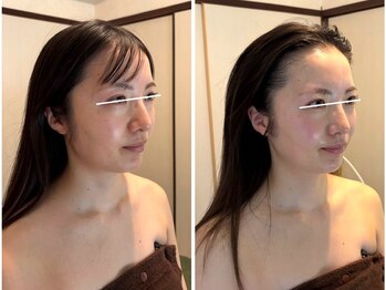 にっこりビューティーの写真/韓国発☆話題の美容法≪エアバリ≫導入★美肌＆引き締め効果に驚愕!ダウンタイムなし!内側から潤う美肌へ☆