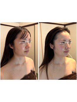 ホウレイ線・たるみ改善！予防ケア